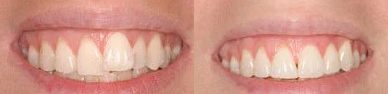 Invisalign Correction - Smile enhancement with Invisalign.