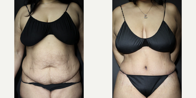 35-44 year old woman treated with Mommy Makeover - 41-year-old woman treated with  Mommy MakeoverWeight: 205 pounds Height: 52 BMI: 36Areas of liposuction: upper abdominal midline, waist, back bra rolls, upper backTime After Surgery: 1 month