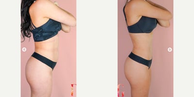 35-44 year old woman treated with Mommy Makeover, Tummy Tuck, Breast Lift with Implants - 35-44 year old woman treated with Mommy Makeover, Breast Lift with Implants, Tummy Tuck