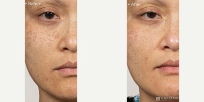 Woman treated with Laser Resurfacing, Fractional Laser - Incredible results of Clear + Brilliant after 6 treatment sessions! This treatment works by creating microscopic treatment zones in the skin, stimulating natural collagen production, and replacing damaged cells with healthy, glowing skin.Benefits include reducing the appearance of fine lines, improving pigmentation and skin radiance, minimizing pores, and giving a refreshed, youthful lookall with minimal downtime.