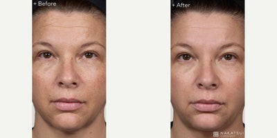 Woman treated with Laser Resurfacing, Fractional Laser - Remarkable results from Clear + Brilliant after just 6 treatment sessions! This innovative treatment creates tiny micro-treatment zones in the skin, promoting natural collagen production and replacing damaged cells with fresh, radiant skin.Key benefits include reducing fine lines, improving pigmentation and overall skin radiance, minimizing pores, and delivering a refreshed, youthful appearanceall with minimal downtime.