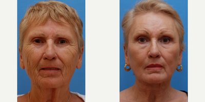 65-74 year old woman treated for Rejuvenation of her Skin - In order to address the skin wrinkling and texture changes, skin resurfacing was combined with fat injections.