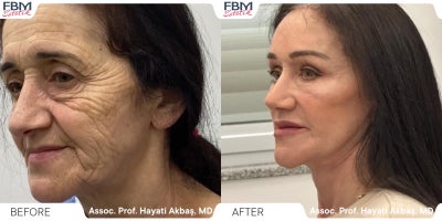 55-64 year old woman treated with Deep Plane Facelift, Forehead Reduction, Eyelid Surgery, Lip Lift - 55-64 year old woman treated with Deep Plane Facelift, Forehead Reduction, Eyelid Surgery, Lip Lift