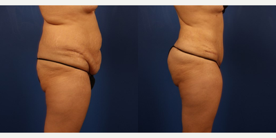 Fat Transfer - Patient is a pleasant female with no shape to hear rear and wanted a more youthful rear end.