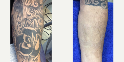 25-34 year old man treated with Enlighten - Multiple Qswitch sessions. 3 with Cutera Enlighten Picosecond.