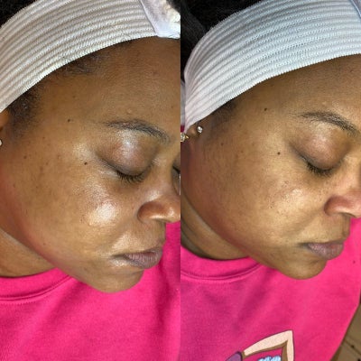 25-34 year old woman treated with Dermaplaning - Dermaplaning before and after