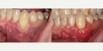 35-44 year old man treated with Gingival Graft - Connective tissue graft