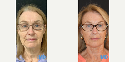 55-64 year old woman treated with Skin Tightening - Morpheus8 Skin Tightening and Remodeling -- Post 3 Treatments