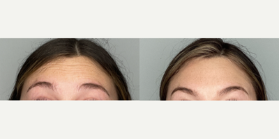 25-34 year old woman treated with Xeomin - patient treated with Xeomin