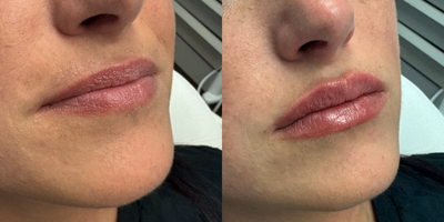 25-34 year old woman treated with Revanesse - patient treated with one syringe of Revanesse Lips