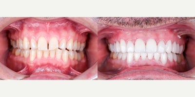 35-44 year old man treated with Dental Bonding, Dental Crown - This patient wanted a complete smile transformation, including closing gaps and enhancing tooth shape. We used full ceramic crowns on both upper and lower arches to rebuild structure, improve symmetry, and achieve a brighter, more balanced look. The result is a dramatic yet natural changeand a confident new smile.