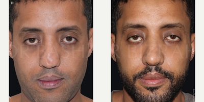 Woman treated with Sinus Surgery - Blocked Nose