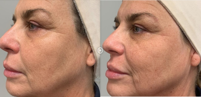 Woman treated with Dermaplaning - Woman treated with Dermaplaning