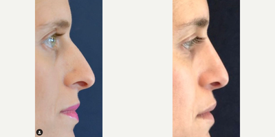 Woman treated with Rhinoplasty - Rhinoplasty before and after