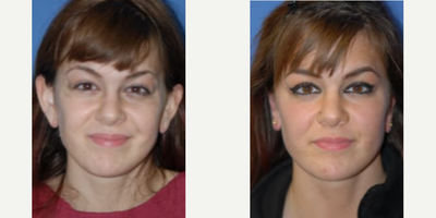 Woman treated with Ear Surgery - Woman treated with Ear Surgery through ear reshaping and closing of gauge holes.