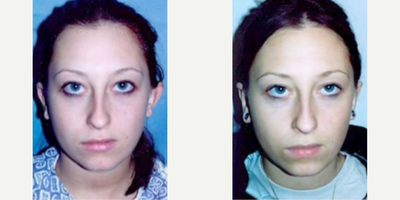 Woman treated with Ear Surgery - Woman treated with Ear Surgery