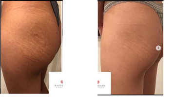 25-34 year old woman treated with Carboxytherapy - Carboxytherapy is a non-surgical cosmetic medicine treatment. Carboxytherapy injections infuse gas carbon dioxide below the skin through a needle. It stimulates blood flow, improves the skin's elasticity and reduce the appearance of cellulite and stretch marks although it has not been clinically tested you can see it for yourself - here I present my patient Before and after 10 treatments for stretch marks.