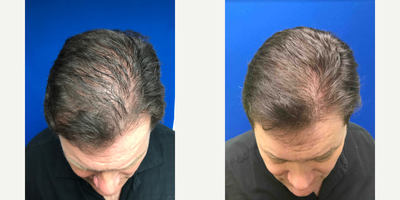 55-64 year old woman treated with Hair Loss Treatment - This good looking guy had some thinning of his hair and early male pattern baldness. We have done two treatments of our specialized PRP preparation.