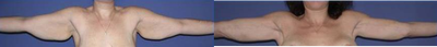Arm Lift and Body Lift - Arm Lift (Brachioplasty) and Body Contouring