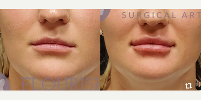 Woman treated with Vollure, Lip Fillers - This beautiful patient has been working towards her lip goals. We have previously used 1 syringe of vollure, just before quarantine with the plan to add another 4 weeks later as she wanted to go bigger. In a lot of patients, staged treatments usually lead to the best results. She is shown here before and immediately after 1 syringe of Juvederm Vollure. (2nd syringe total) She wanted to really highlight her upper lip and make her lips more proportional. 