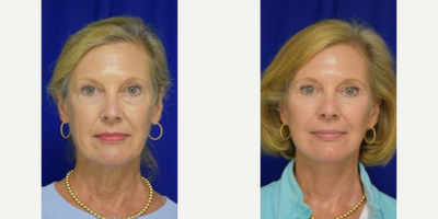 1923 55-64 year old woman treated with Facelift, Double Eyelid Surgery, Neck Lift - 45-54 year old woman treated with Facelift, Neck Lift, Facial Fat Transfer, Eyelid Surgery
