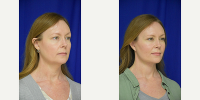 2775 45-54 year old woman treated with Facelift, Brow Lift, Buccal Fat Removal, Eyelid Surgery, Facial Fat Transfer - 45-54 year old woman treated with Facelift, Neck Lift, Facial Fat Transfer, Eyelid Surgery