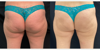 Early Results After Just 1 Of 3 QWO Treatments - Though a series of 3 treatments are needed for full results, improvement can already be seen here 6 weeks after just 1 treatment with QWO