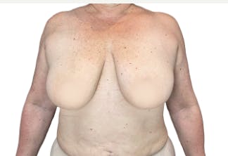 35-44 year old woman treated with Breast Reduction, Breast Reconstruction, Breast Lift - In this case a breast reduction with breast lift was performed. You can see the outcome of this surgical procedure typically manifests itself as fuller breasts with improved projection and natural-looking curves with enhanced volume in both the upper and middle parts of the breast area. Furthermore, because it was all done using your own body tissue. The final result is improved self-confidence due to aesthetically pleasing results achieved through minimal scarring in an L shape incision.