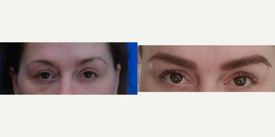 35-44 year old woman treated with Eyebrow Transplant - Female patient had one Eyebrow Transplant of 564 follicles. Photos are before and 15 months post-op.