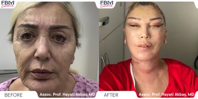 45-54 year old woman treated with Deep Plane Facelift, Brow Lift, Eyelid Surgery, Facial Fat Transfer, Cheek Lift - 45-54 year old woman treated with Deep Plane Facelift, Brow Lift, Eyelid Surgery, Facial Fat Transfer, Cheek Lift