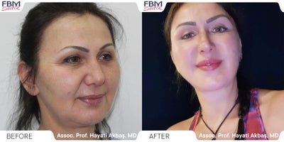 35-44 year old woman treated with SMAS Facelift - 35-44 year old woman treated with SMAS Facelift