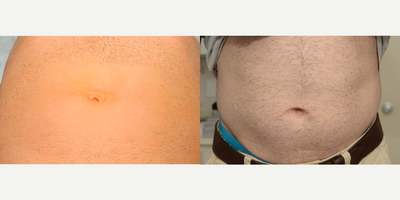 45-54 year old man treated with Umbilical Hernia Repair - The diverse field of Plastic & Reconstructive Surgery offers far more than breast augmentations and Botox! Bringing Plastic Surgical techniques & expertise to general surgical operations such as hernia repair, South Shore Plastic & Reconstructive Surgery performs Aesthetic Hernia Repair; minimizing the classic scars left by hernia repair while reconstructing stretched out, deformed belly buttons! These photos were taken before, immediately following, and 3 months after repair of an umbilical hernia with Umbilicoplasty. Of course, individual results may vary depending on the exact characteristics of your particular hernia