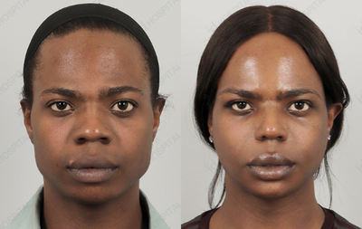 25-34 year old woman treated with Facial Feminization Surgery - Female Facial Feminization:Fat Graft + V-line Surgery + High-L Cheekbone Reduction + Brow Bone Reducation + Customized Barbie Line Rhinoplasty