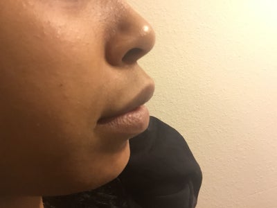 How to fix a long philtrum and protruding lips/mouth? (photos) Doctor ...