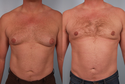 Male Breast Reduction- Gynecomastia - 
	This patient is a 44 year old who was interested in a male breast reduction. During surgery I removed over 150 grams of glandular tissue from the left chest and approximately 50 grams from the right due to a preoperative asymmetry. I also performed power-assisted liposuction to flatten out and blend the areas of fat excess.
