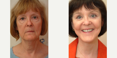 65-74 year old woman treated with SMAS Facelift - S-Lift (includes SMAS) with Marionette line excision.