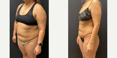 Woman treated with Semaglutide - Woman treated with Semaglutide