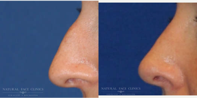 25-34 year old woman treated with Rhinoplasty - Patient had functional septorhinoplasty with major septal repair, Cosmetic hump reduction