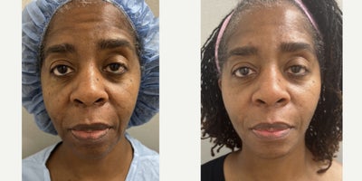 45-54 year old woman treated with Facelift - 54 y/o, 3 months after NaturalLift facelift in our office OR under sedation.