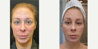 35-44 year old woman treated with Facelift, Deep Plane Facelift, Eyelid Surgery - 40 y.o female who had massive weight loss and underwent deep plane facelift, neckift and upper blepharoplasty.She was awake yet comfortable for the procedure