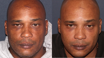 35-44 year old man treated with Skin Lightening - This patient got Clear + Brilliant by Dr. Wu. This was to treat overall evening up of skin tone and discoloration. Pore size. Skin smoothness, lightening and brightening.