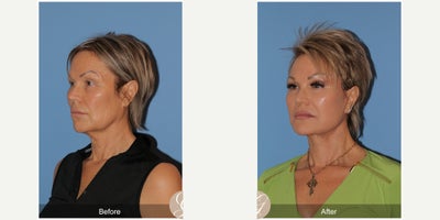 59 year old woman treated with Deep Plane Facelift, Facelift, Neck Lift, TCA Peel - 59 year old woman treated with Deep Plane Face and Neck Lift, TCA Peel