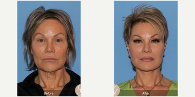 59 year old woman treated with Deep Plane Facelift, Facelift, Neck Lift, TCA Peel - 59 year old woman treated with Deep Plane Face and Neck Lift, TCA Peel