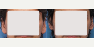 Woman treated with Earlobe Repair - Woman treated with Earlobe Repair