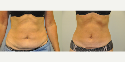 44 year old woman treated with CoolSculpting - 44 year old female shown 8 weeks after coolsculpting of the lower abdomen