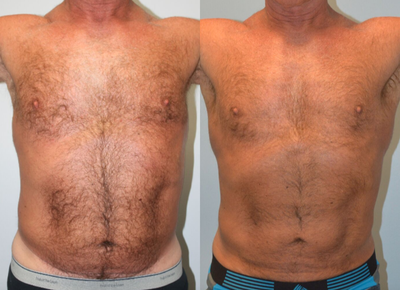 Vaser Liposuction - This 61-year old patientcame to Dr. Chad Deal requesting a reduction in fat in the abdomen area. Dr. Deal recommended liposuction for the flanks and abdomen to provide better contouring. Surgery was performed in our AAAHC-accredited surgery center