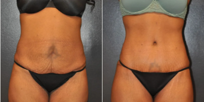 Woman treated with Tummy Tuck - Woman treated with Tummy Tuck