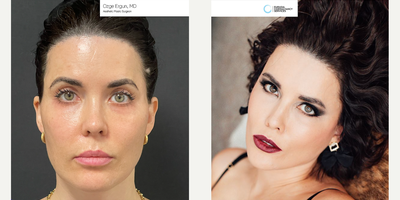 35-44 year old woman treated with Facelift - Facelift