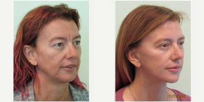 45-54 year old woman treated with Facelift and Upper Blepharoplasty - This woman in her 50's presented with a long standing history of sun exposure as well as varying weight over the years. She wished for improvement of her neck, jawline, and heaviness of her upper eyelids.She had attempted botox and fillers over the years and felt that they were insufficient in improving the droopiness that she noted in her lower face and eyelids.We consulted together and decided to proceed with a lower facelift/necklift and upper eyelid lift (aka blepharoplasty). The procedure was performed with administration of oral xanax prior to the treatment, as well as local anesthesia (no IV or general anesthesia necessary). The total procedure time was under 2 1/2 hours and she was able to return to most normal activities in 10 days.Her results demonstrate a tighter neck and jawline, along with significant opening of her upper eyelids. She stated that after the procedure her eyes actually felt less heavy to her and both felt and looked more awake. Eye makeup application was much easier, and enjoyable, for her afterwards as well.