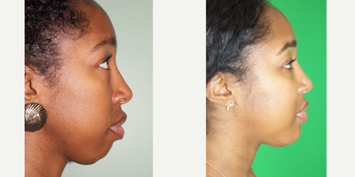 25-34 year old woman concerned about her profile - This young lady present with concerns about her lack of chin projection.  She had several consults with other surgeons that recommended chin implants.  She consulted with me and I recommended a sliding genioplasty.  The procedure occurred under general anesthesia through and oral incision (no external scar).  She had about a 7 mm advancement.